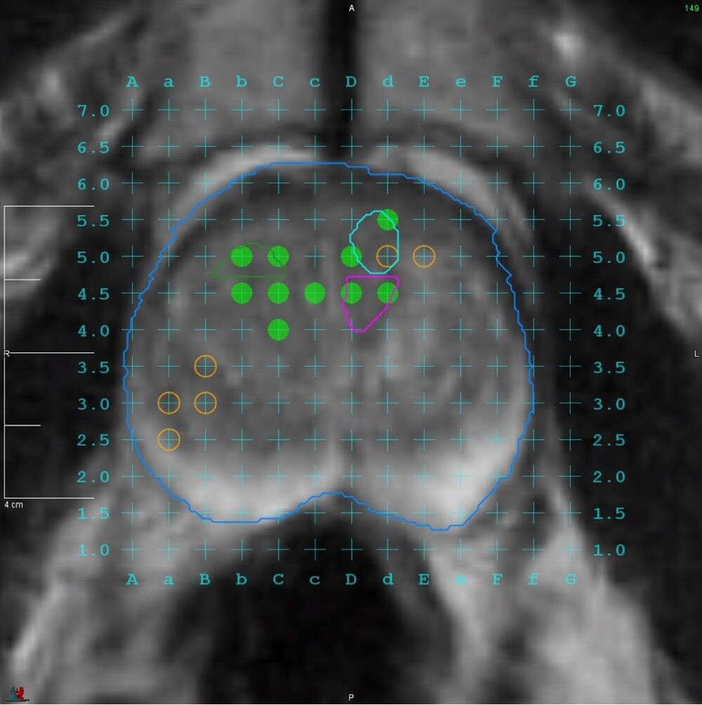 Monitor care arată pregătirea imaginilor de rezonanță magnetică pentru fusion biopsy, la Spitalul Clinic SANADOR.